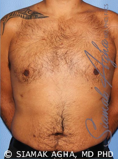 Gynecomastia Surgery Before & After Photo Gallery - Patient #7