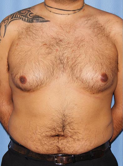 Breast Reduction Before and After Photos: Look Out for These 6