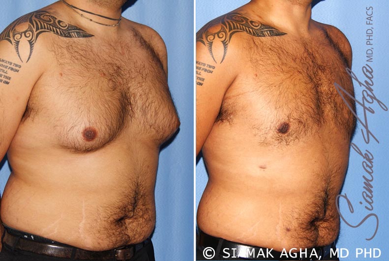 orange county male breast reduction patient 7 front right Newport Beach, CA