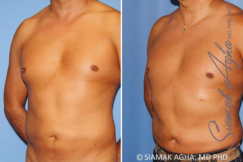 Orange County Male Breast Reduction Patient 8 Front Left Newport Beach, CA