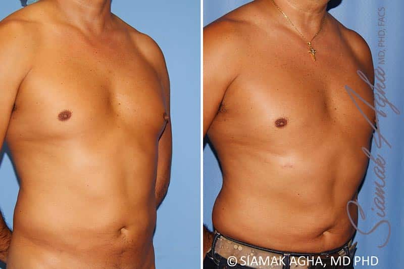 Male Breast Reduction Patient 8