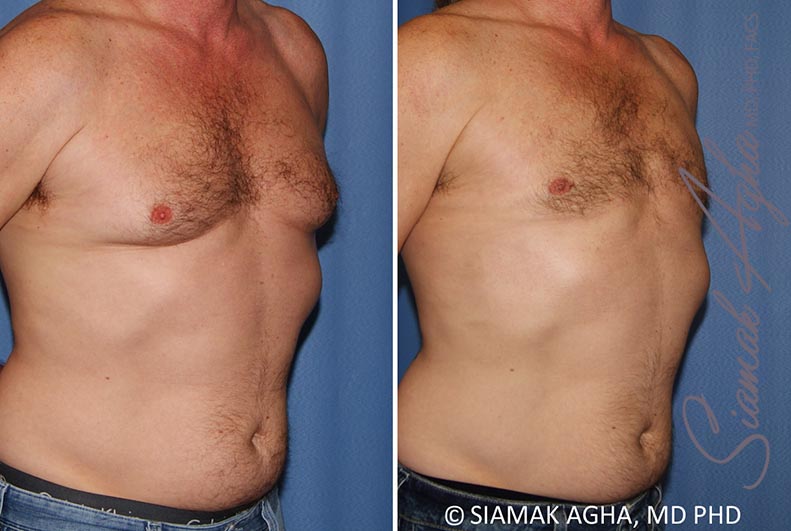 Male Breast Reduction Patient 9