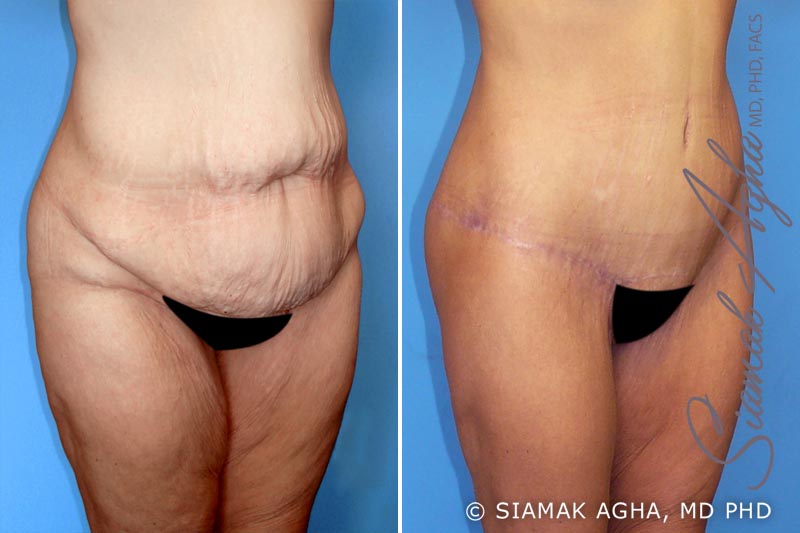 orange county spiral thigh lift patient 1 front right Newport Beach, CA
