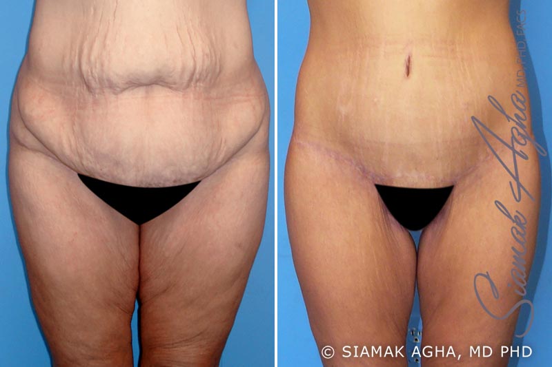 Thigh Procedures Before and After Photo Gallery