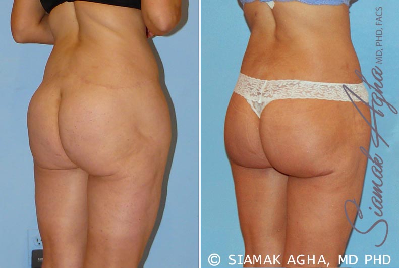 orange county spiral thigh lift patient 4 back right Newport Beach, CA