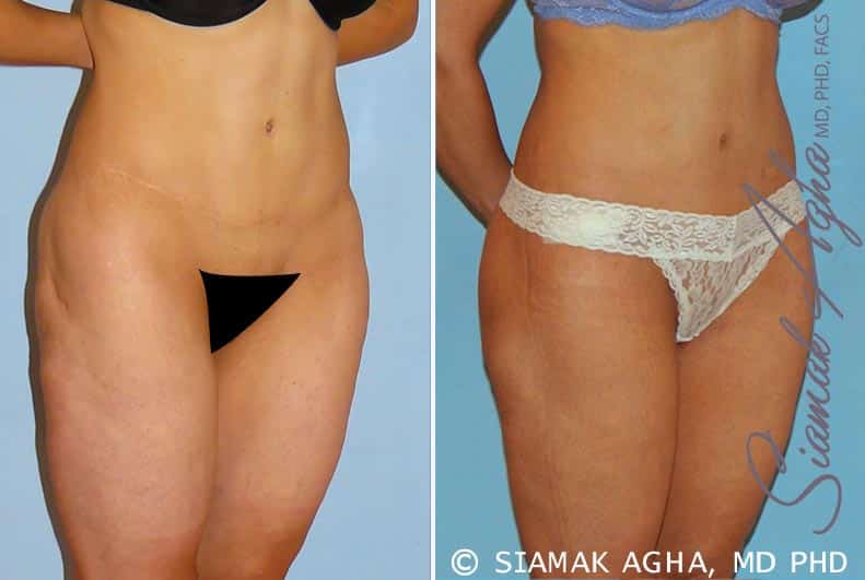 orange county spiral thigh lift patient 4 front right Newport Beach, CA