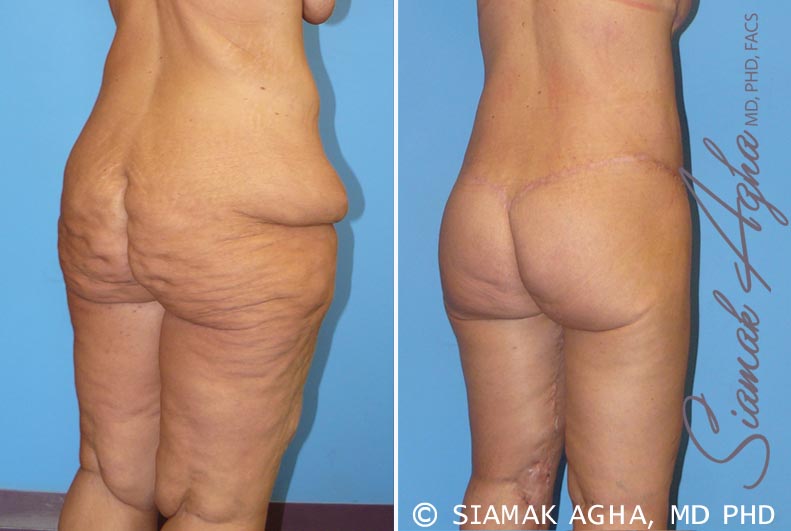 orange county spiral thigh lift patient 5 back right Newport Beach, CA