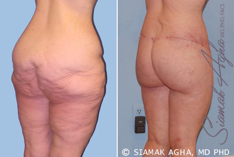 orange county spiral thigh lift patient 6 back right Newport Beach, CA