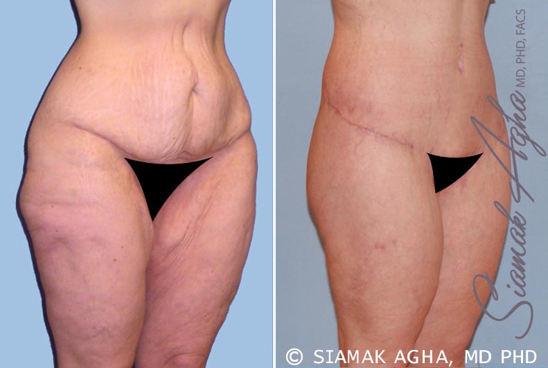 orange county spiral thigh lift patient 6 front right Newport Beach, CA
