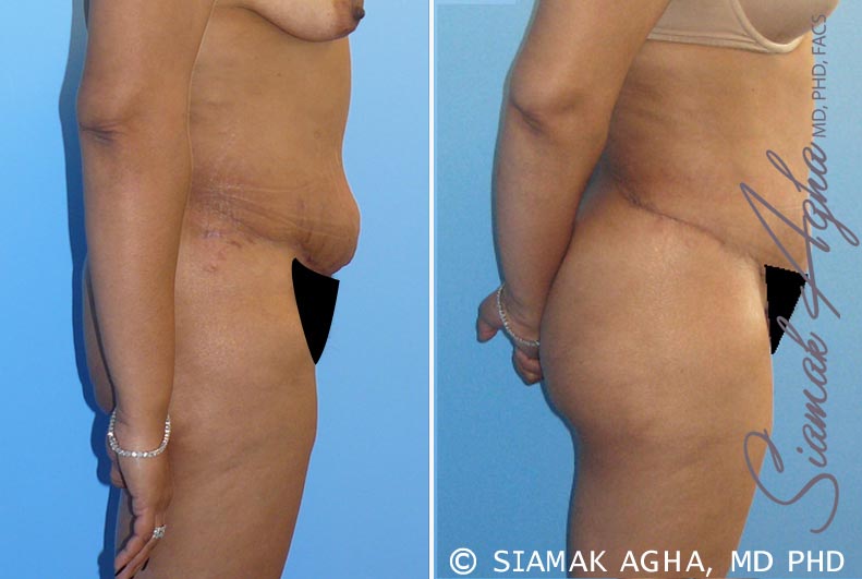 Tummy Tuck Revision Patient 1