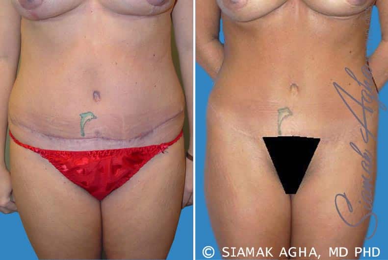 Tummy Tuck Revision Patient 2