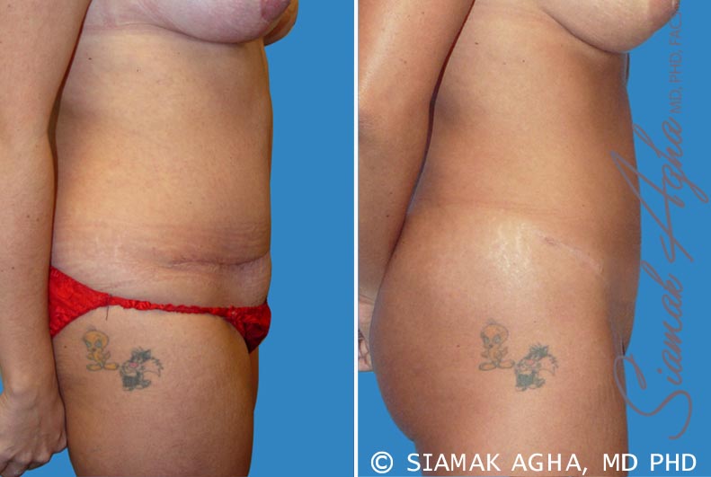 Tummy Tuck Revision Patient 2