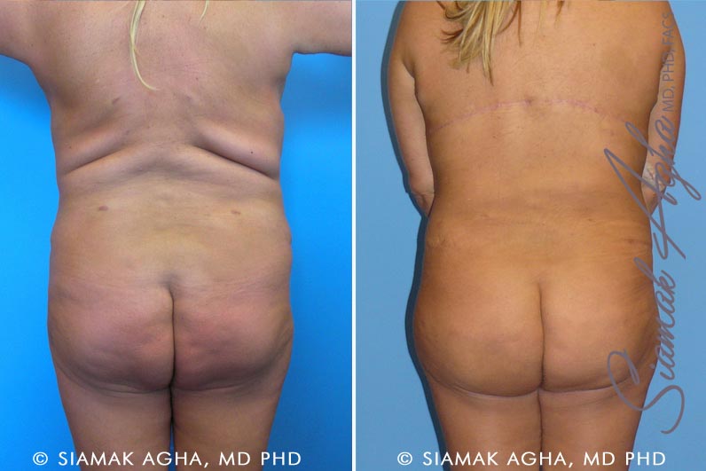 Tummy Tuck Revision Patient 3