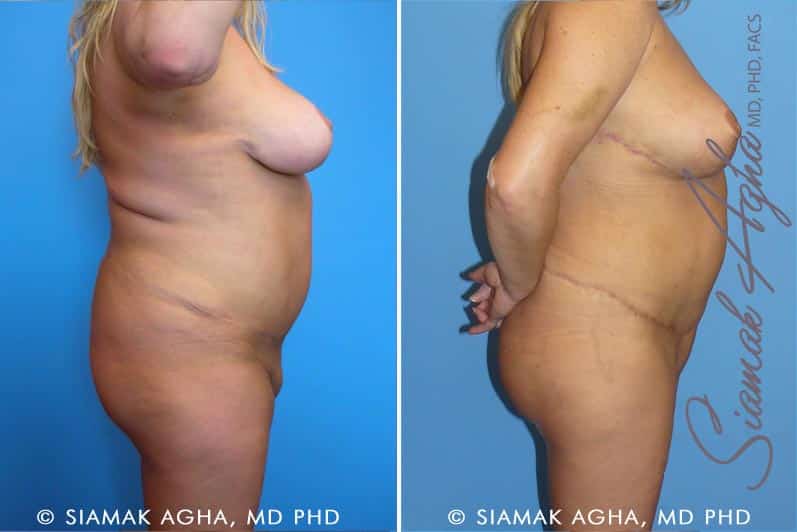 Tummy Tuck Revision Patient 3