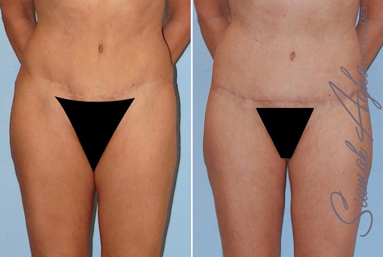Tummy Tuck Revision Patient 4