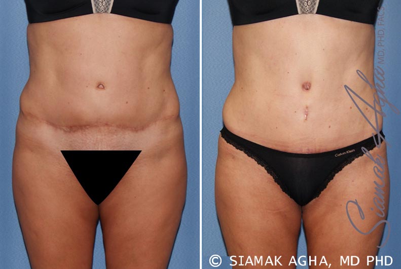 Tummy Tuck Revision Patient 7