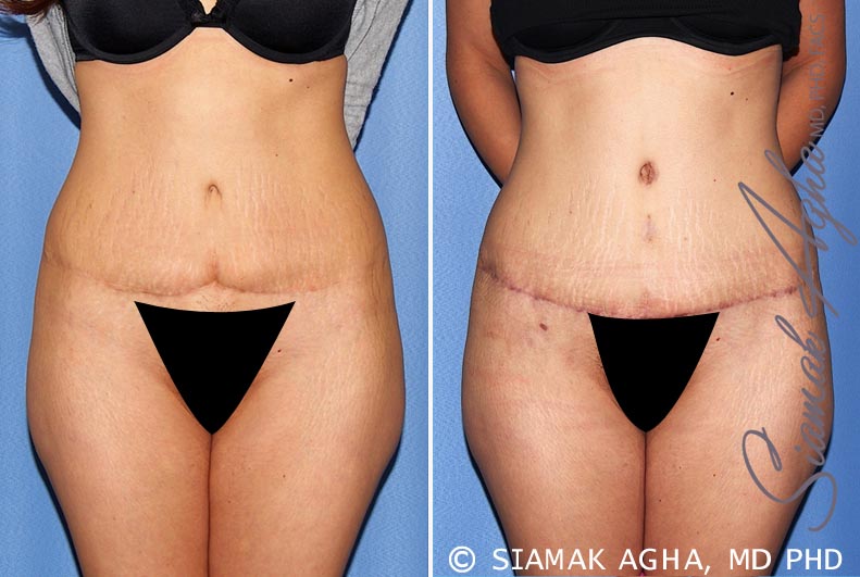 Tummy Tuck Revision Patient 9