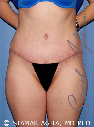 Can a Tummy Tuck Treat Stretch Marks? - Cosmetic Surgeons of Michigan, P.C.