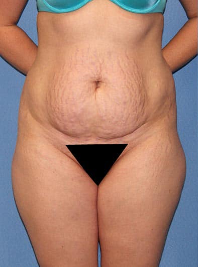 Can a Tummy Tuck Treat Stretch Marks? - Cosmetic Surgeons of Michigan, P.C.