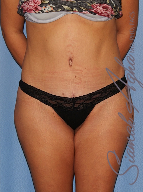 Tummy Tuck Surgery Before & After Photo Gallery - Patient #38