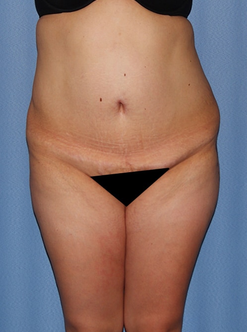 Tummy Tuck Surgery Before & After Photo Gallery - Patient #38