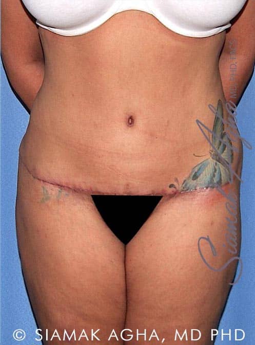 Tummy Tuck Revision Surgery Before & After Photo Gallery - Patient #10