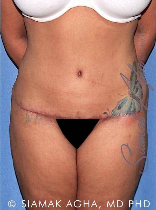 Avoid a Tummy Tuck Revision: Get Great Results