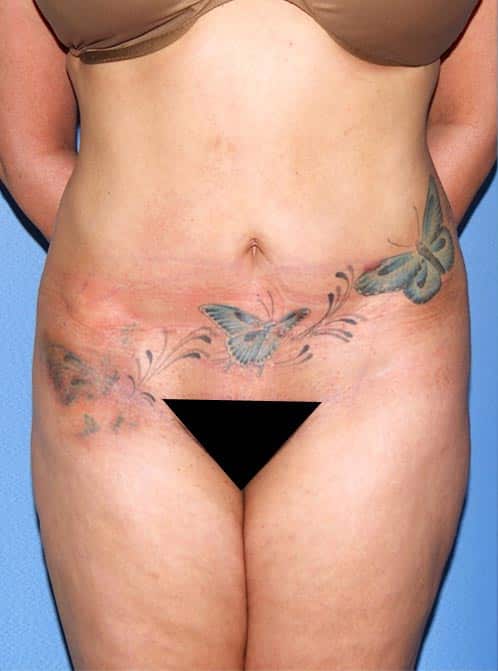 Tummy Tuck Revision Surgery Before & After Photo Gallery - Patient #10