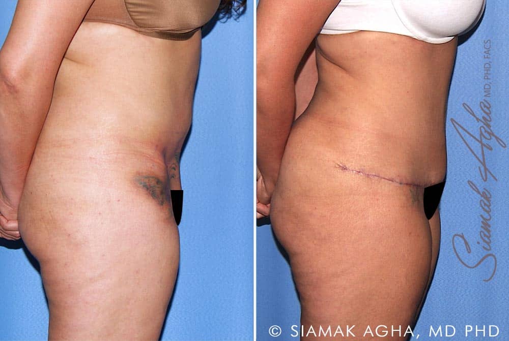 Tummy Tuck Revision Patient 10