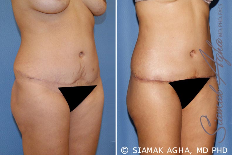Tummy Tuck Revision Patient 11