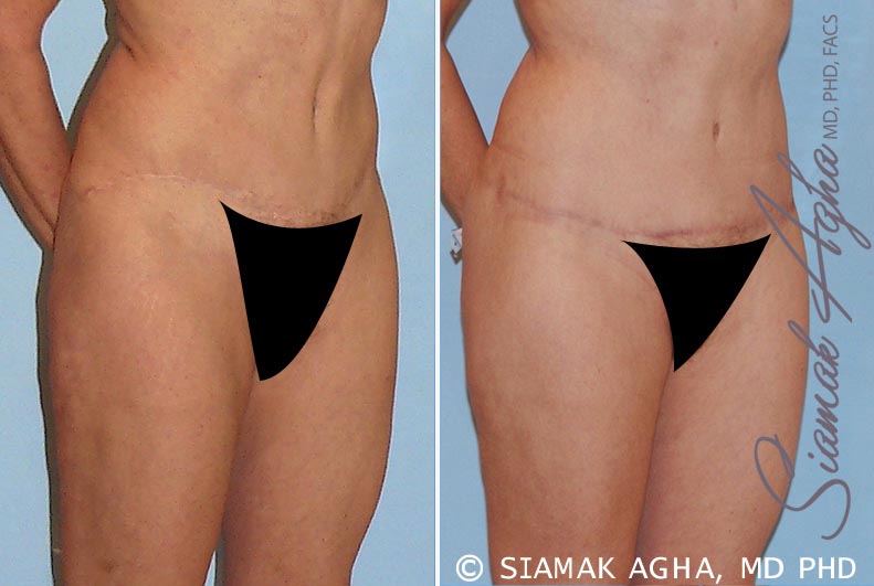 Tummy Tuck Revision Patient 4