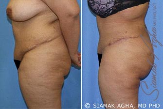 Tummy Tuck Revision Patient 5