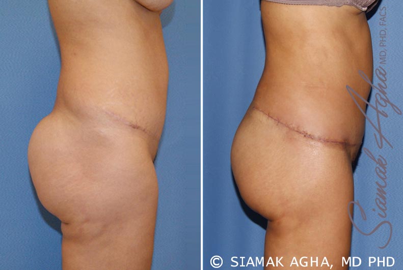Tummy Tuck Revision Patient 6