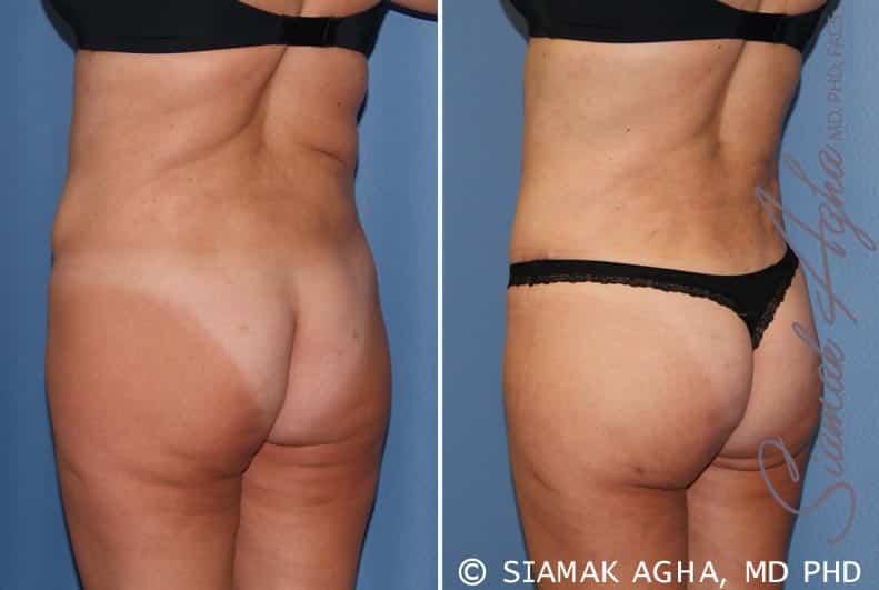 Tummy Tuck Revision Patient 7