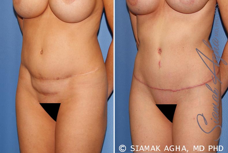 Tummy Tuck Revision Patient 8