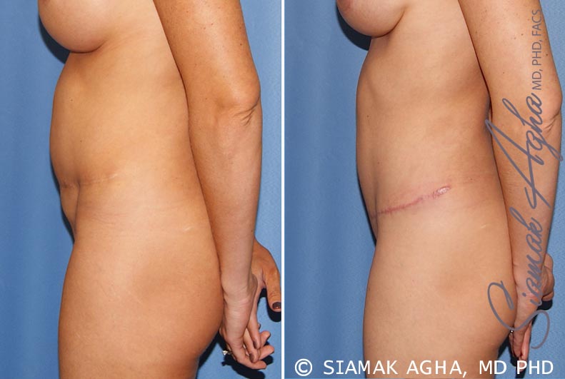 Tummy Tuck Revision Patient 8