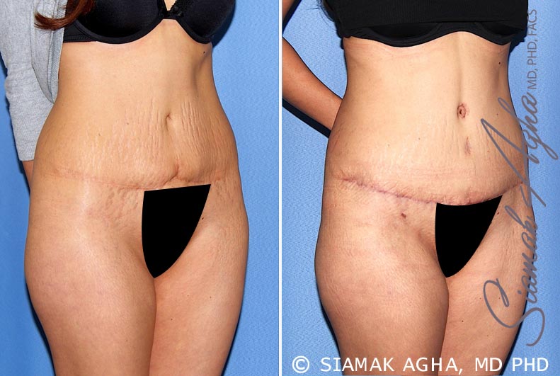 Tummy Tuck Revision Patient 9