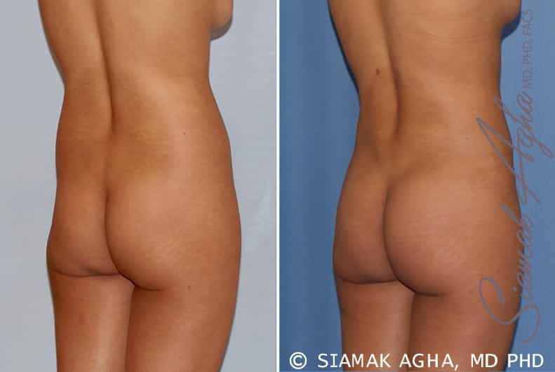 Liposuction Patient 14