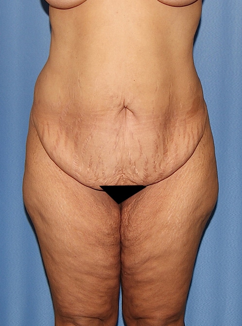 Lower Body Lift Surgery Before & After Photo Gallery - Patient #24