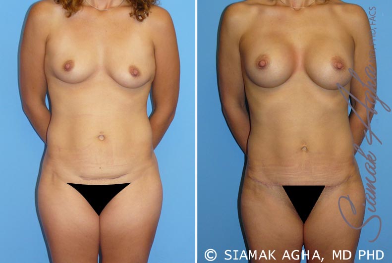 Tummy Procedures Before and After Photo Gallery