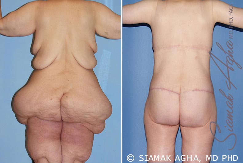 Bruggeman Plastic Surgery & Aesthetics - Flank #liposuction is a minimal  invasive outpatient procedure that removes fat around the sides and back of  the waste line. We perform this procedure in office