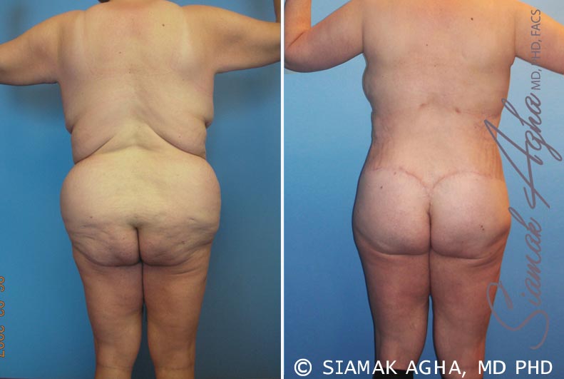 Plastic Surgery Case Study - The Vertical Backlift for Waistline