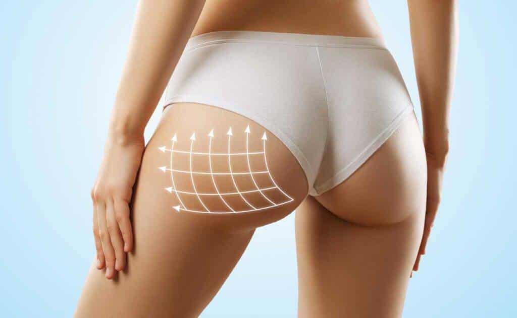 VelaShape Treatments : Reduce Cellulite