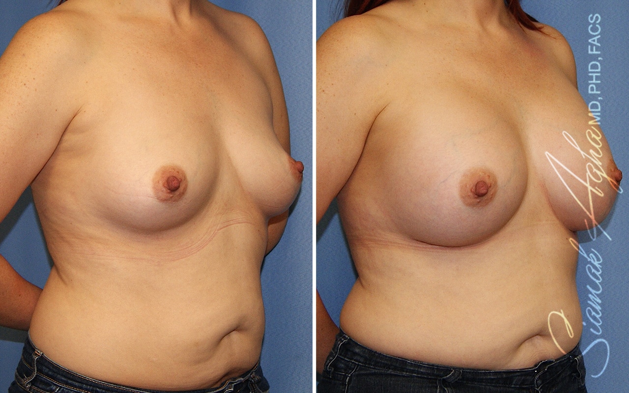 Breast Augmentation Patient 46
