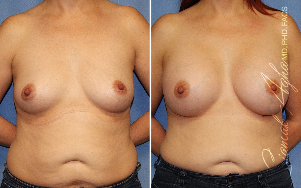 orange county breast augmentation patient 46 front Newport Beach, CA