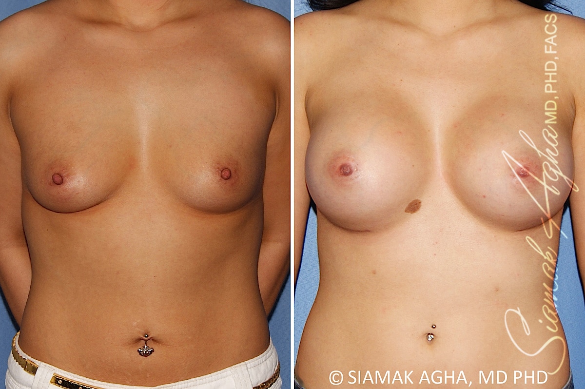 orange county breast augmentation patient 47 front Newport Beach, CA