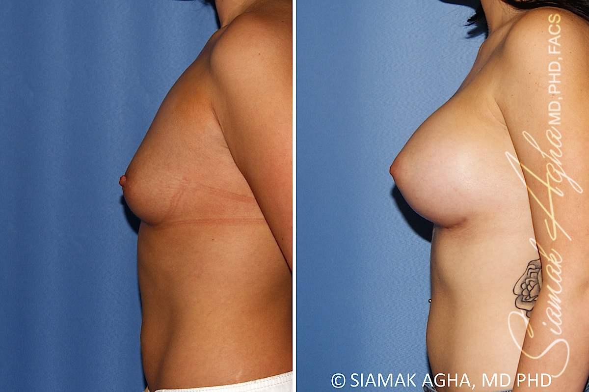 Breast Augmentation Patient 47
