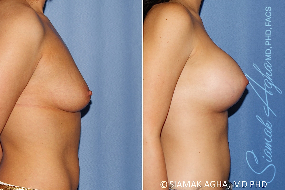 Breast Augmentation Patient 47
