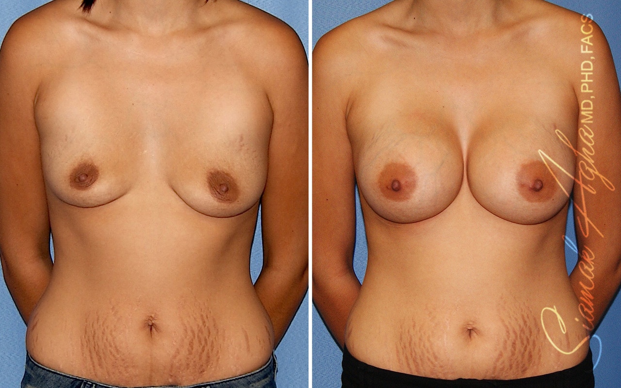 orange county breast augmentation patient 48 front Newport Beach, CA