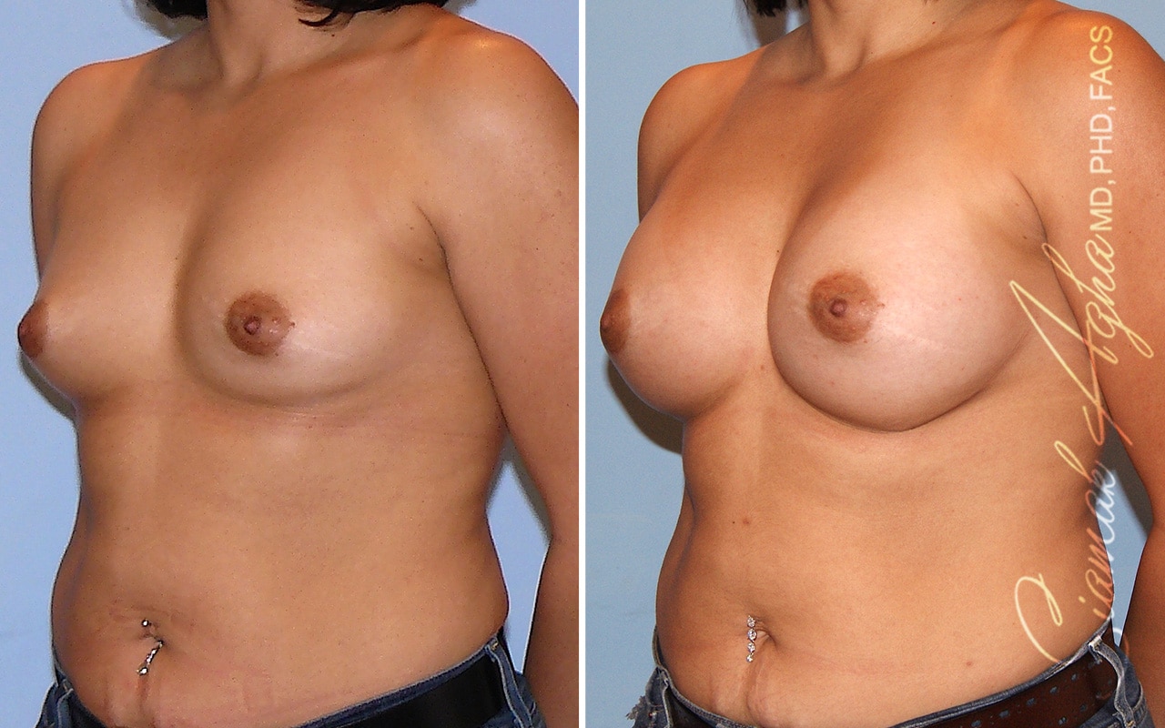 Breast Augmentation Patient 49